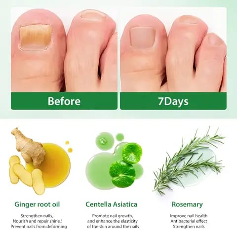 Spray Soin des Ongles au Gingembre – Solution Nourrissante pour des Ongles Plus Sains et Soignés